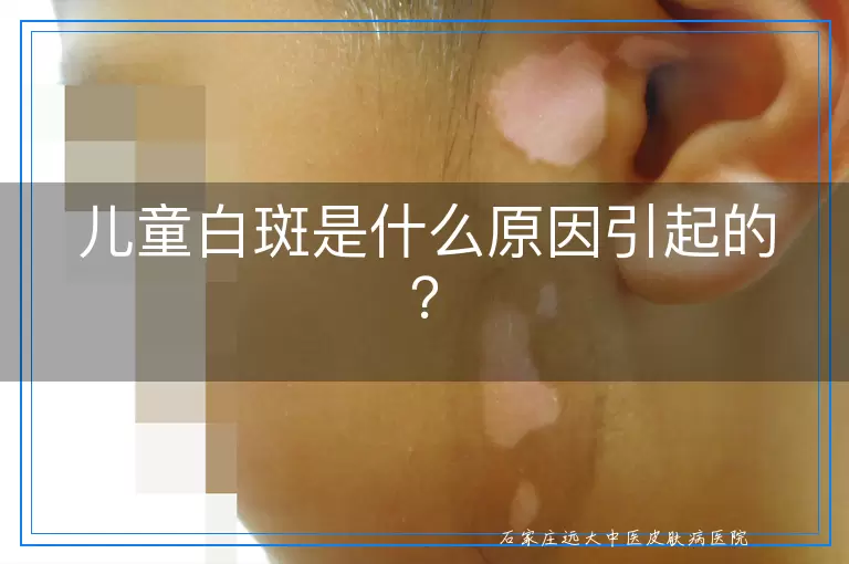 儿童白斑是什么原因引起的？