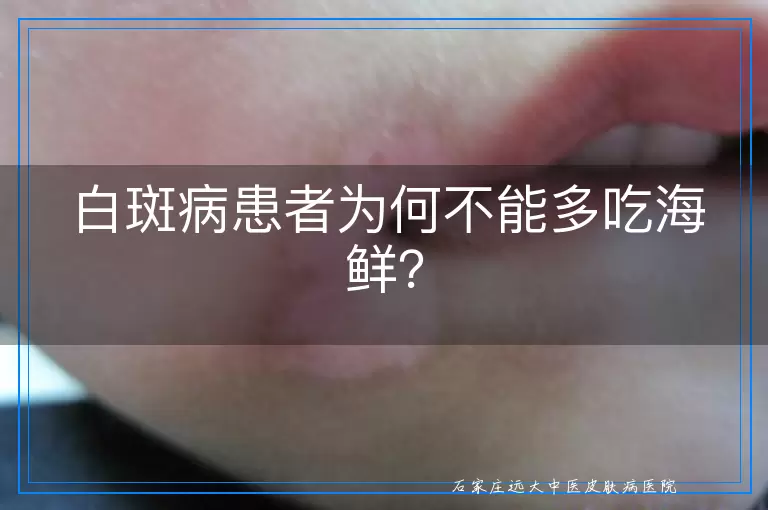 白斑病患者为何不能多吃海鲜？