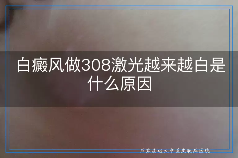 白癜风做308激光越来越白是什么原因