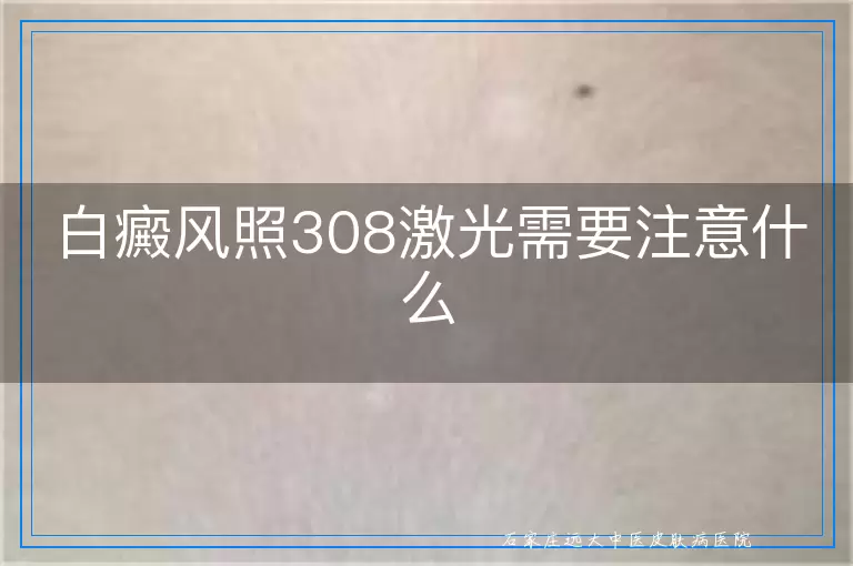 白癜风照308激光需要注意什么