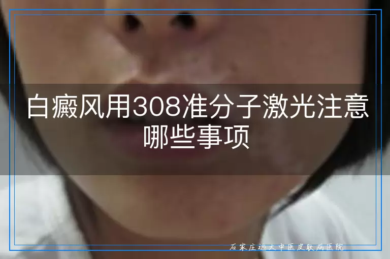 白癜风用308准分子激光注意哪些事项