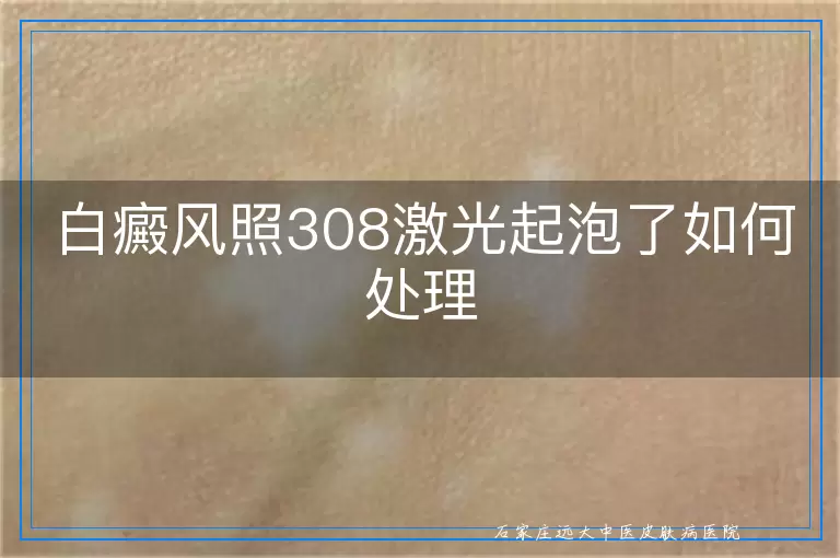 白癜风照308激光起泡了如何处理