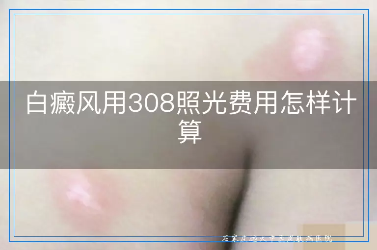 白癜风用308照光费用怎样计算