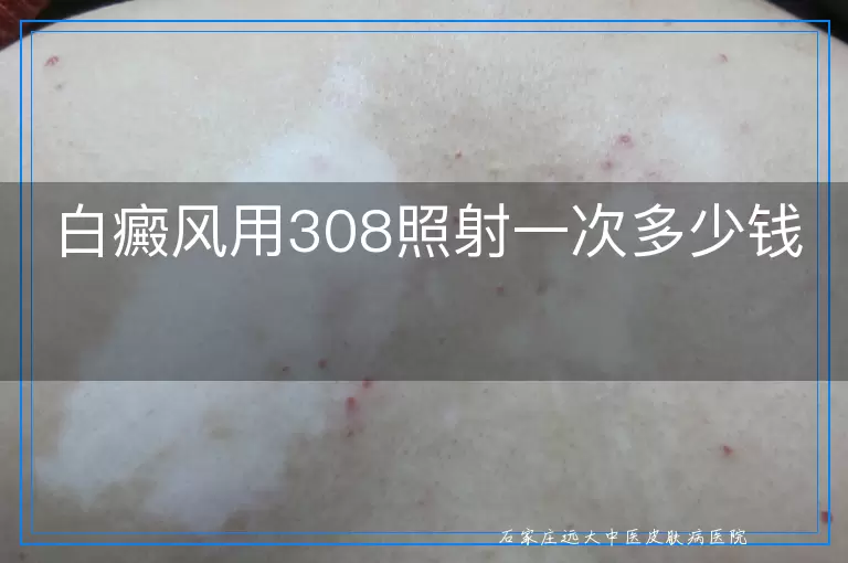 白癜风用308照射一次多少钱