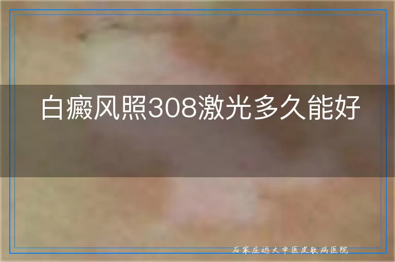 白癜风照308激光多久能好