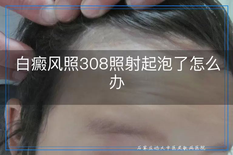 白癜风照308照射起泡了怎么办