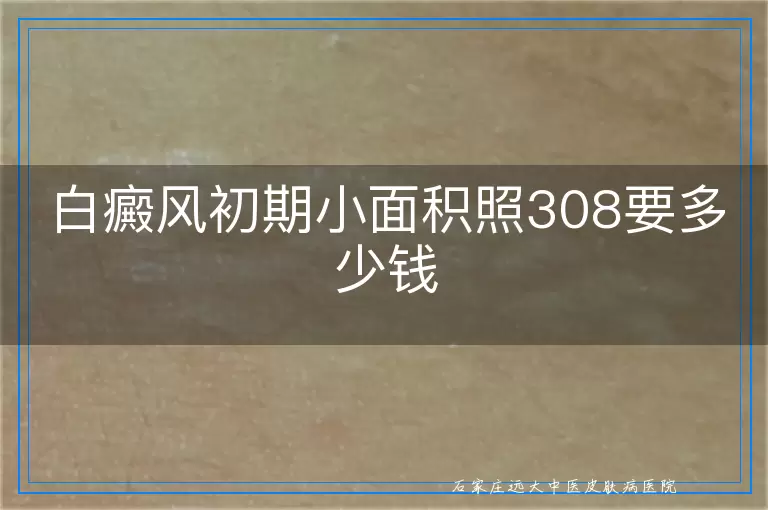 白癜风初期小面积照308要多少钱