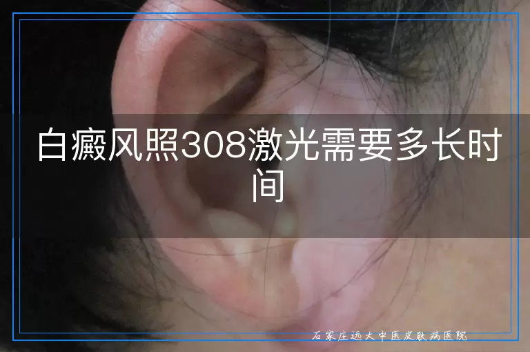 白癜风照308激光需要多长时间