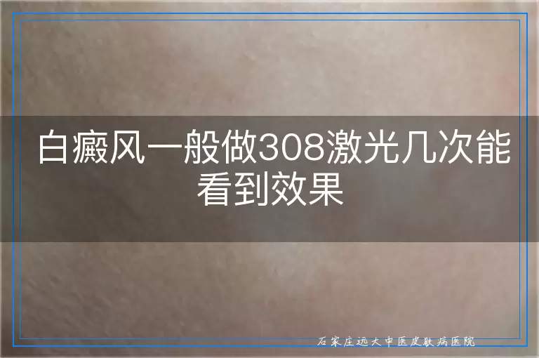 白癜风一般做308激光几次能看到效果