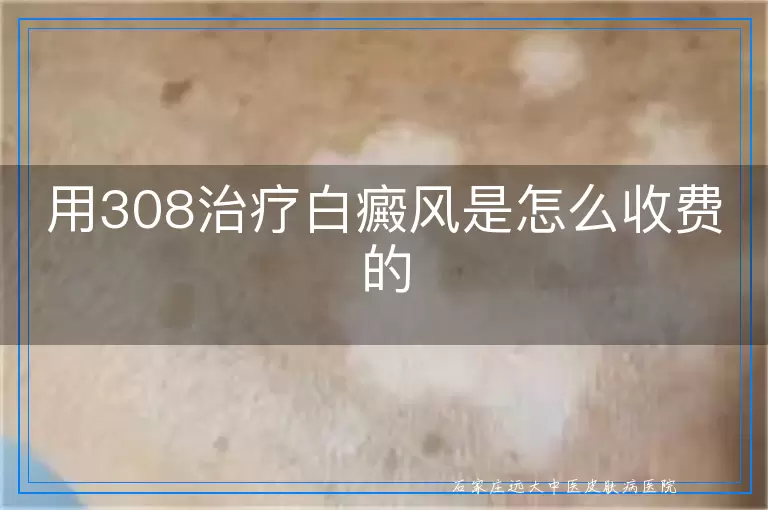 用308治疗白癜风是怎么收费的