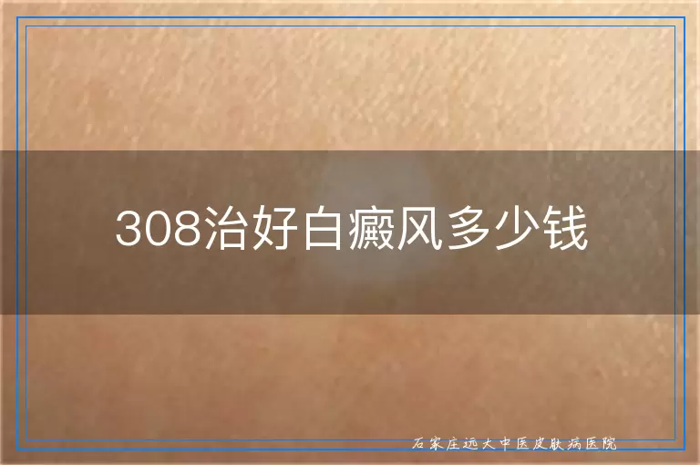 308治好白癜风多少钱