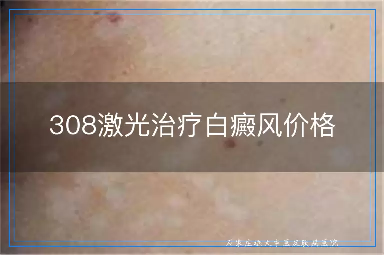 308激光治疗白癜风价格