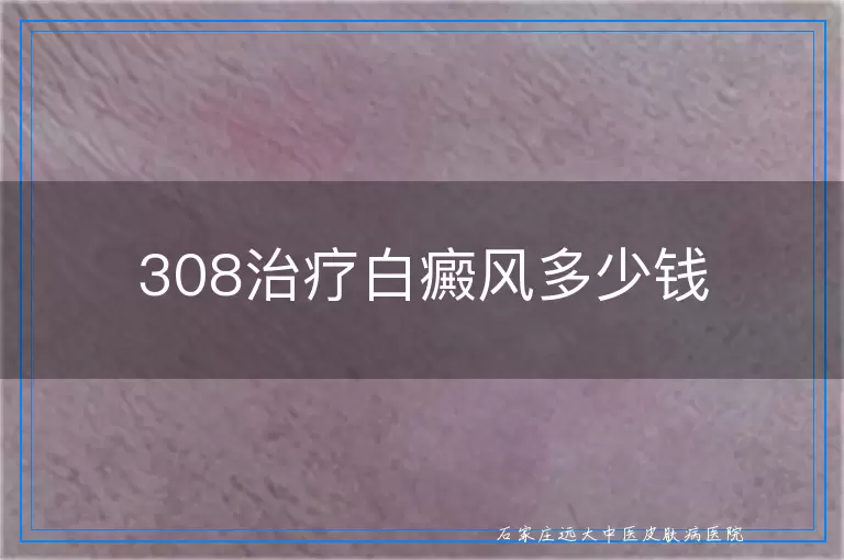 308治疗白癜风多少钱