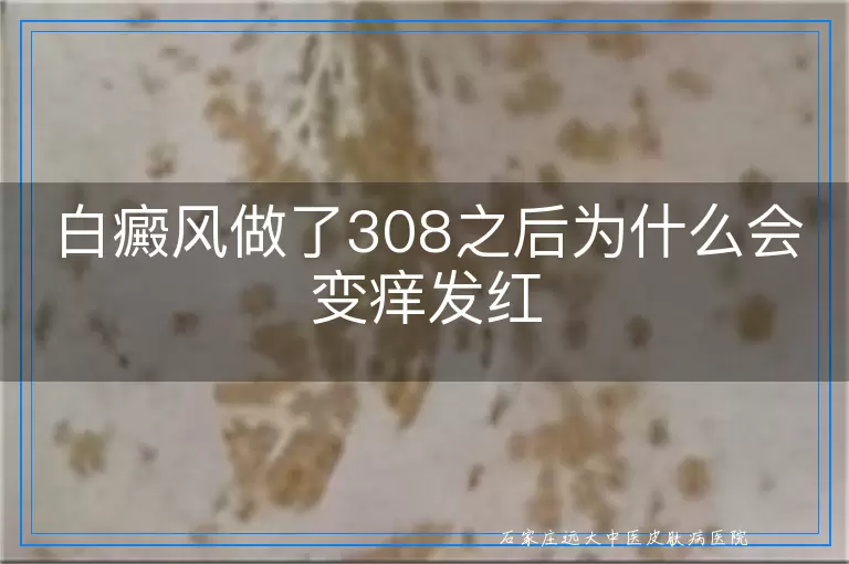 白癜风做了308之后为什么会变痒发红