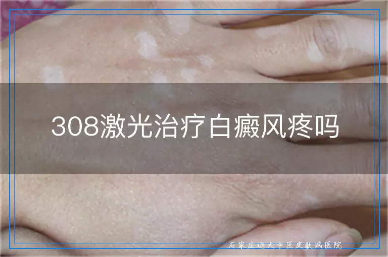 308激光治疗白癜风疼吗