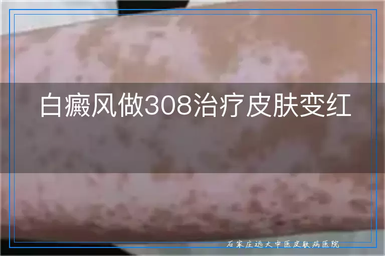 白癜风做308治疗皮肤变红