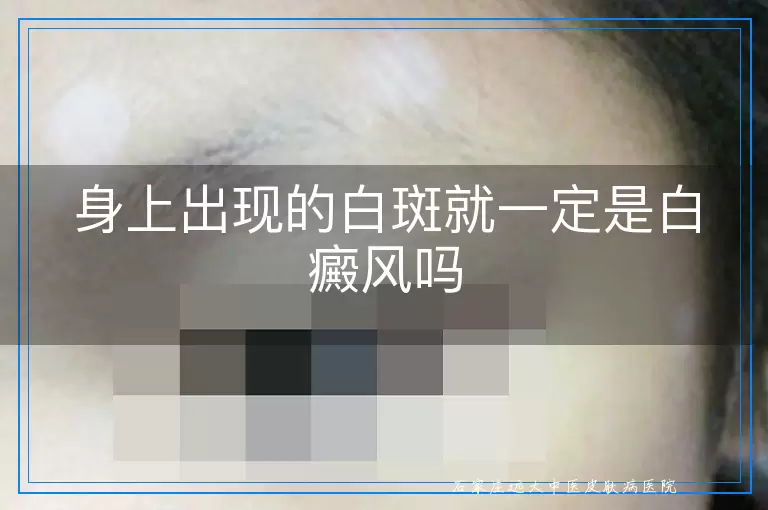 身上出现的白斑就一定是白癜风吗