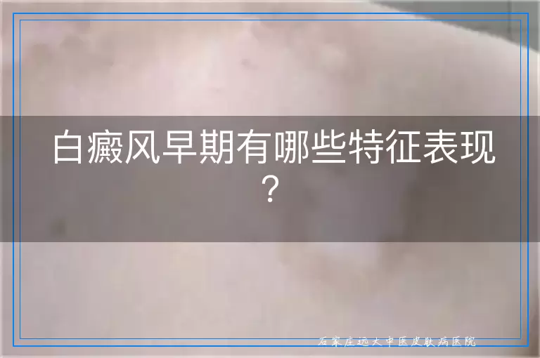 白癜风早期有哪些特征表现？