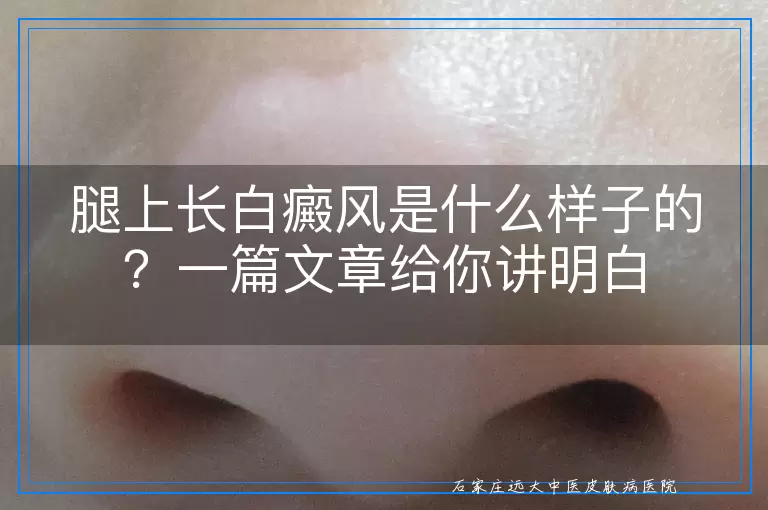 腿上长白癜风是什么样子的？一篇文章给你讲明白