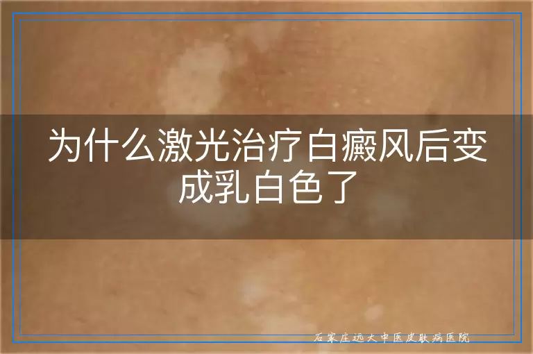 为什么激光治疗白癜风后变成乳白色了