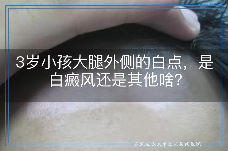 3岁小孩大腿外侧的白点，是白癜风还是其他啥？