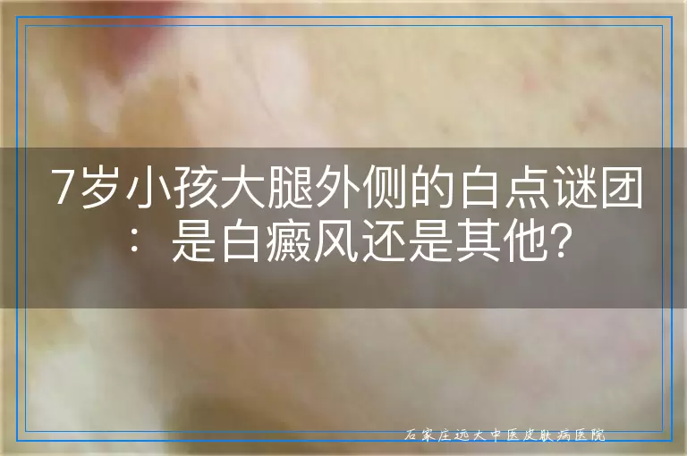 7岁小孩大腿外侧的白点谜团：是白癜风还是其他？