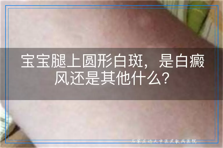 宝宝腿上圆形白斑，是白癜风还是其他什么？