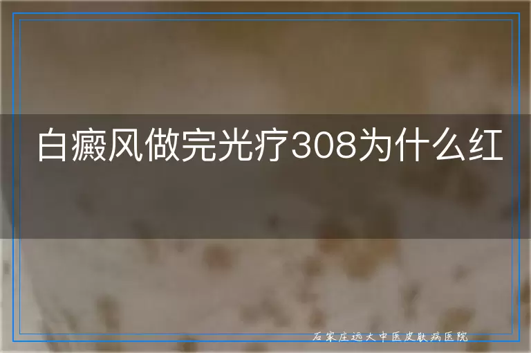 白癜风做完光疗308为什么红