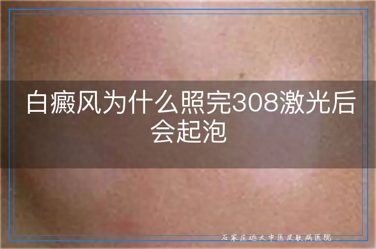 白癜风为什么照完308激光后会起泡