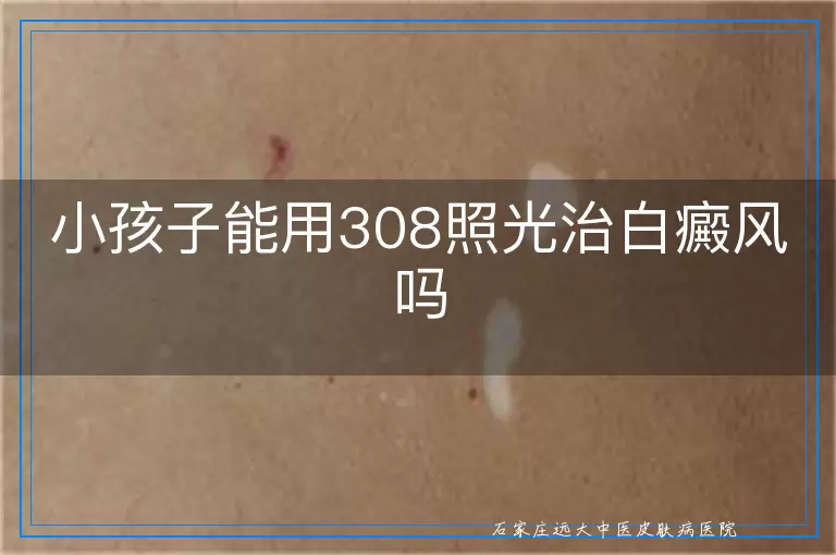 小孩子能用308照光治白癜风吗