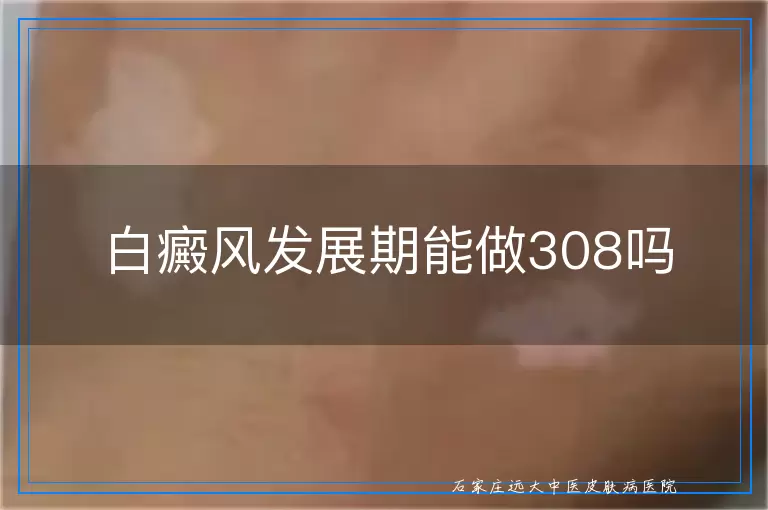 白癜风发展期能做308吗