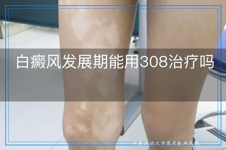 白癜风发展期能用308治疗吗