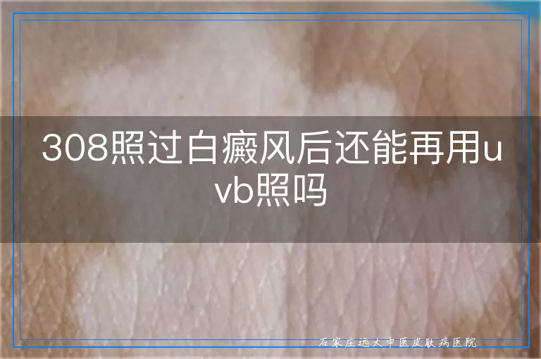 308照过白癜风后还能再用uvb照吗