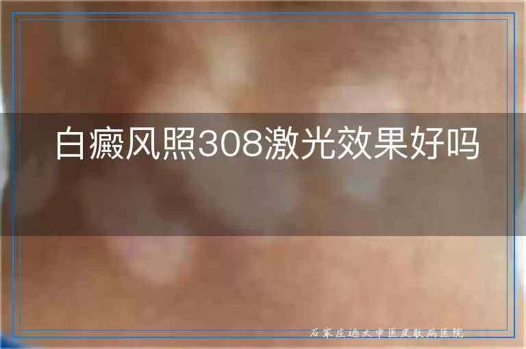 白癜风照308激光效果好吗