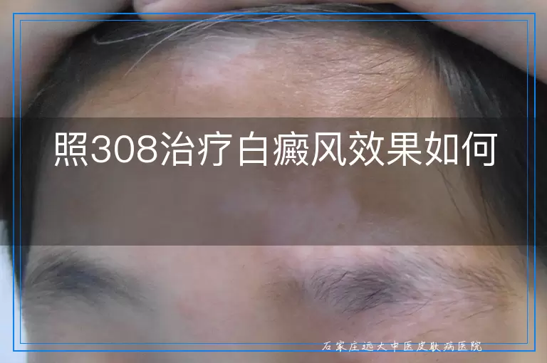 照308治疗白癜风效果如何