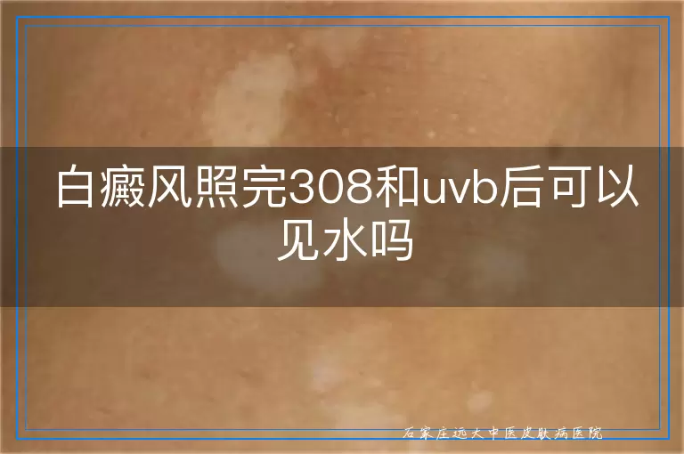 白癜风照完308和uvb后可以见水吗