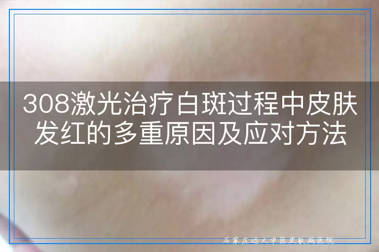 308激光治疗白斑过程中皮肤发红的多重原因及应对方法