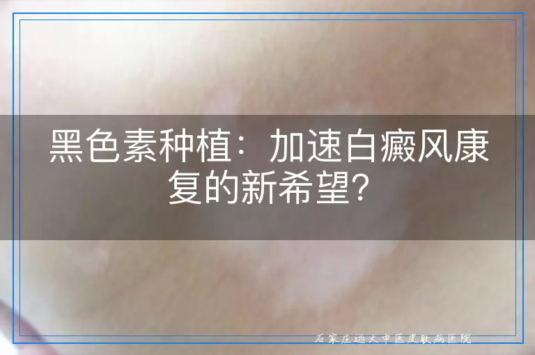 黑色素种植：加速白癜风康复的新希望？