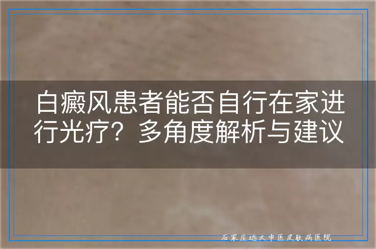 白癜风患者能否自行在家进行光疗？多角度解析与建议