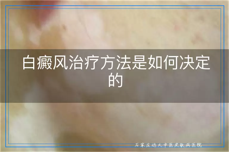 白癜风治疗方法是如何决定的