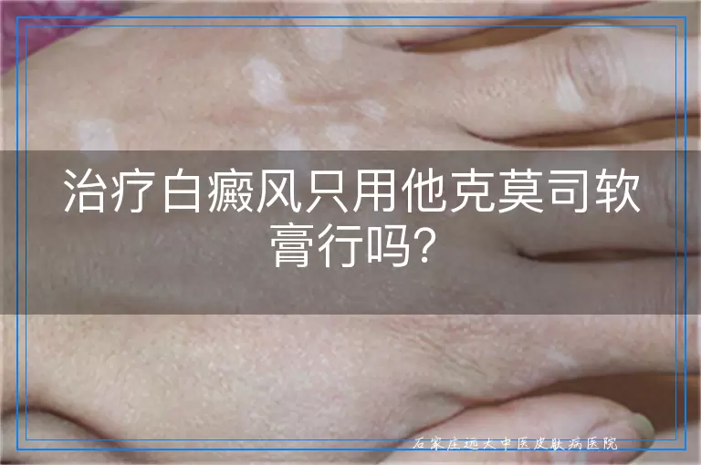 治疗白癜风只用他克莫司软膏行吗？