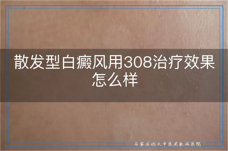 散发型白癜风用308治疗效果怎么样