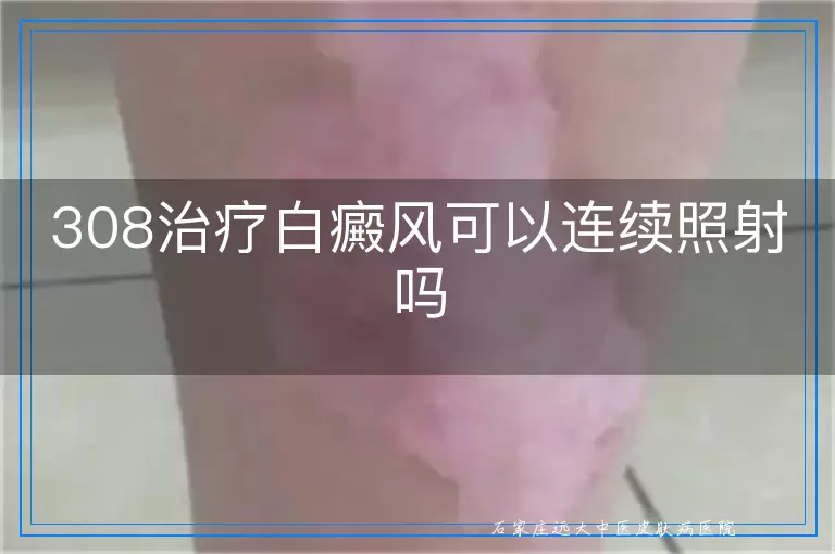 308治疗白癜风可以连续照射吗