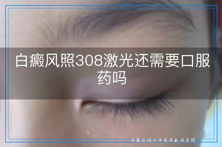 白癜风照308激光还需要口服药吗