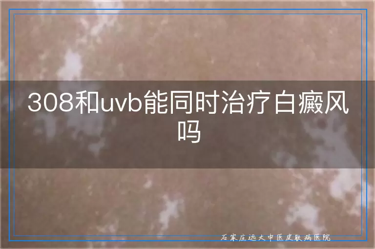 308和uvb能同时治疗白癜风吗