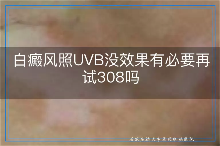 白癜风照UVB没效果有必要再试308吗