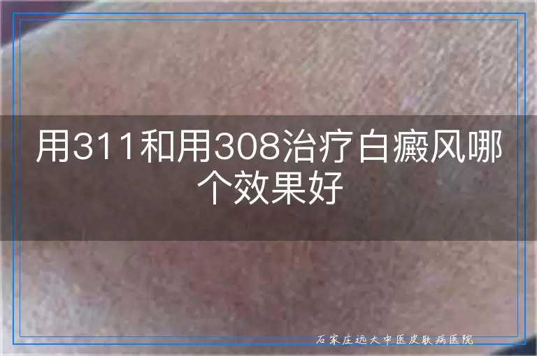 用311和用308治疗白癜风哪个效果好