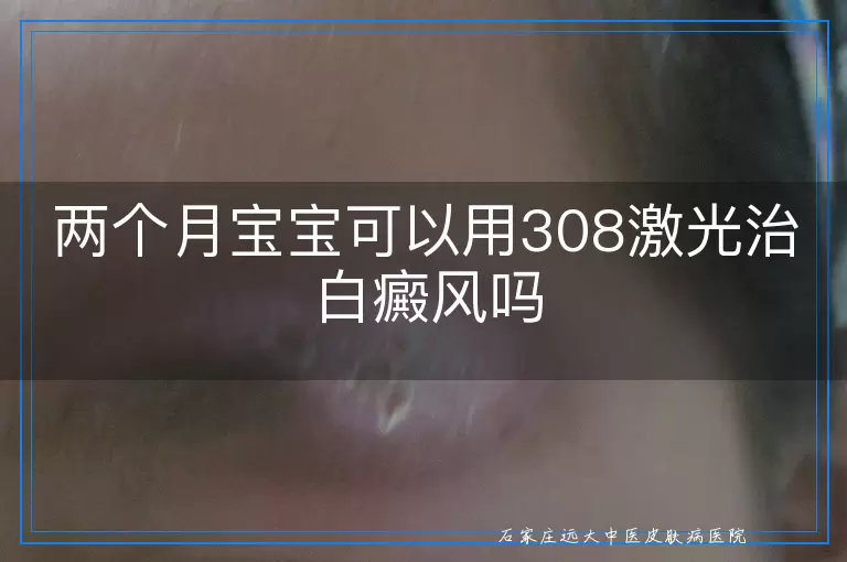 两个月宝宝可以用308激光治白癜风吗