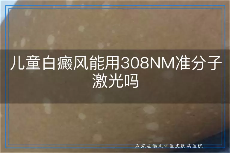 儿童白癜风能用308NM准分子激光吗