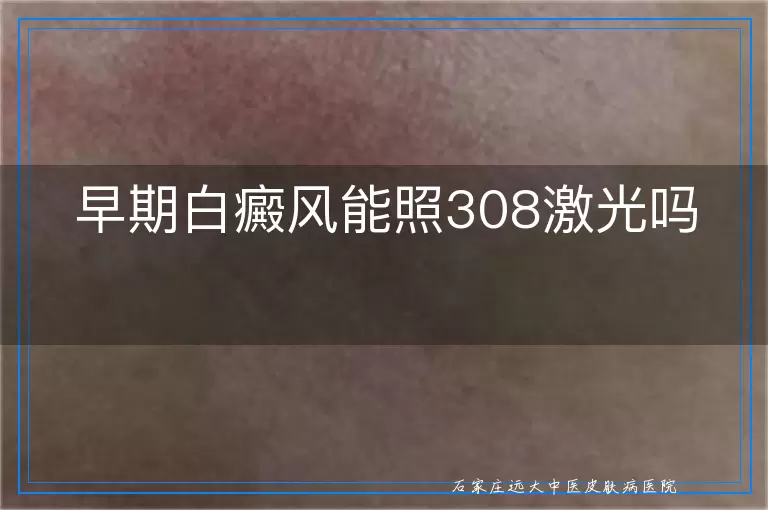 早期白癜风能照308激光吗